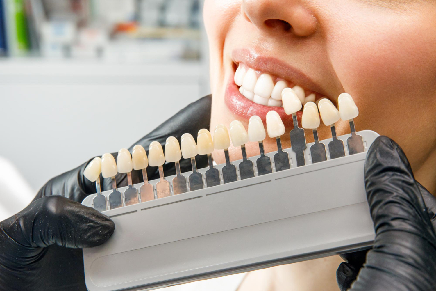 Veneers Dentist in Millcreek, UT Reason to Smile Dental