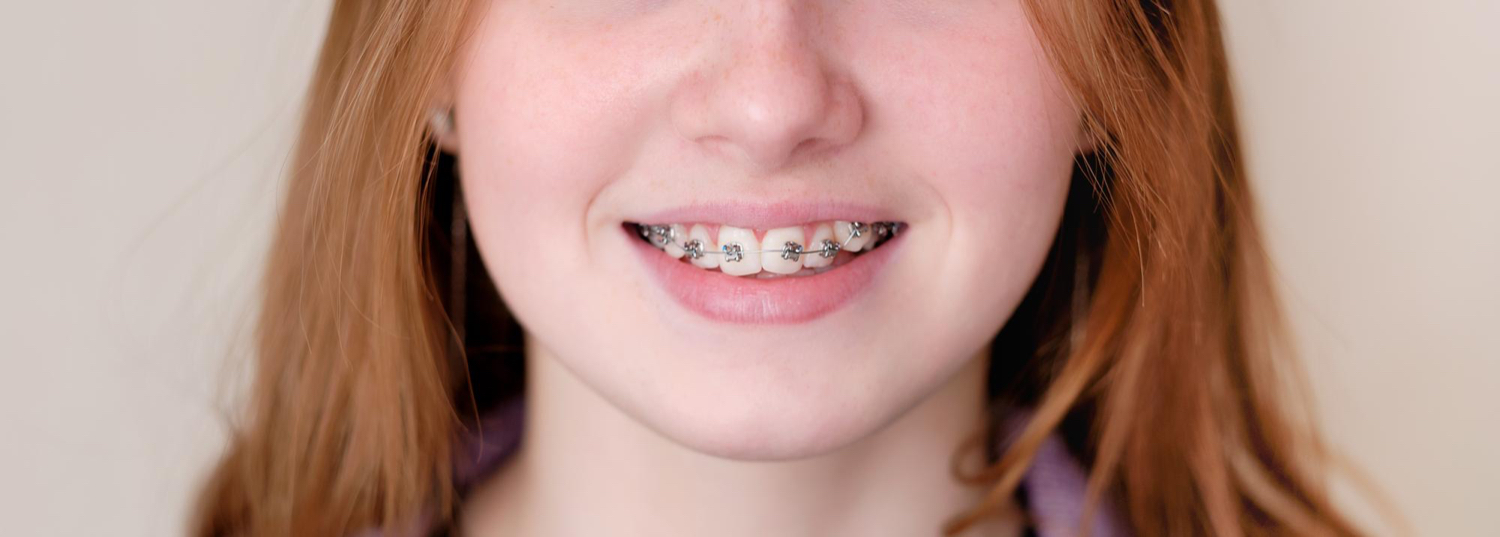 How Teeth Move With Braces Dentist in Millcreek, UT Reason to Smile